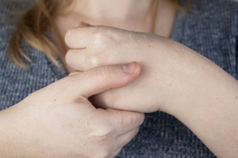 Como prevenir e identificar os sinais iniciais das micoses que ocorrem com frequência no verão